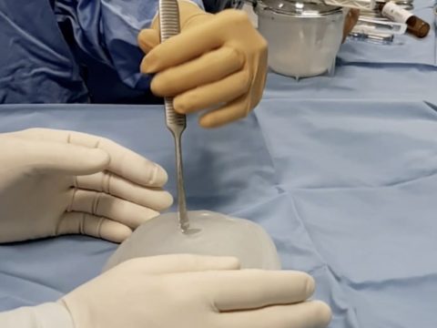 使用3D打印硅胶模具为患者定制个性化颅骨