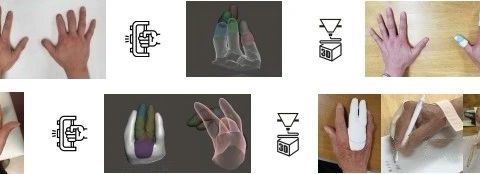 3D打印具有柔软指尖的手指假体