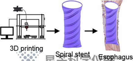 用于不可手术食管恶性肿瘤潜在治疗的 3D 打印柔性聚合物支架